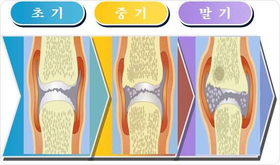 정상적인 무릎관절과 퇴행성관절염 사진