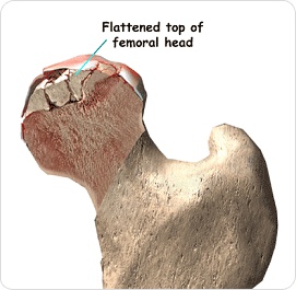 •대퇴골두 무혈성 괴사