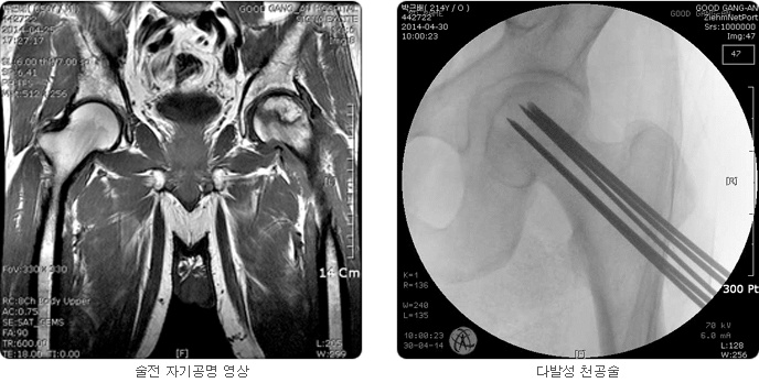 중심부 감압술