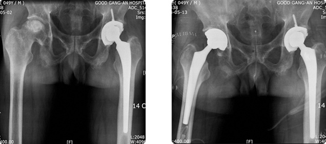  인공고관절 전치환술 사진