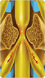척추 협착증의 대표적 모형 사진