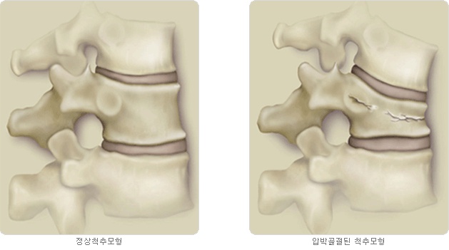 정상척추모형과 압박골절된 척추모형