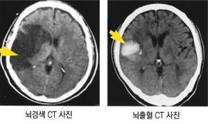 뇌경색 CT