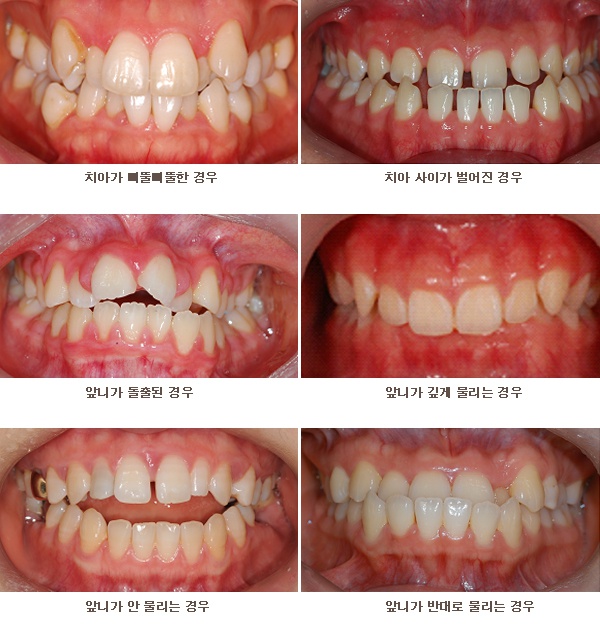 교정치료 대상 치아의 예시 사진