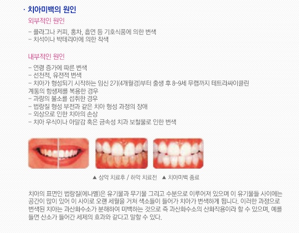 치아미백의 원인 설명
