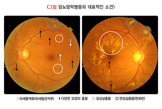 그림 당뇨망막병증의 대표적인 소견
