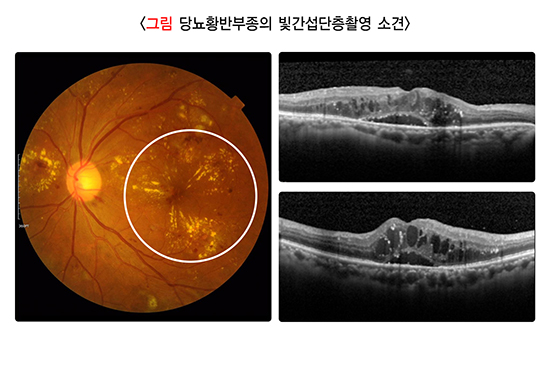 그림 당뇨황반부종의 빛간섭단층촬영 소견