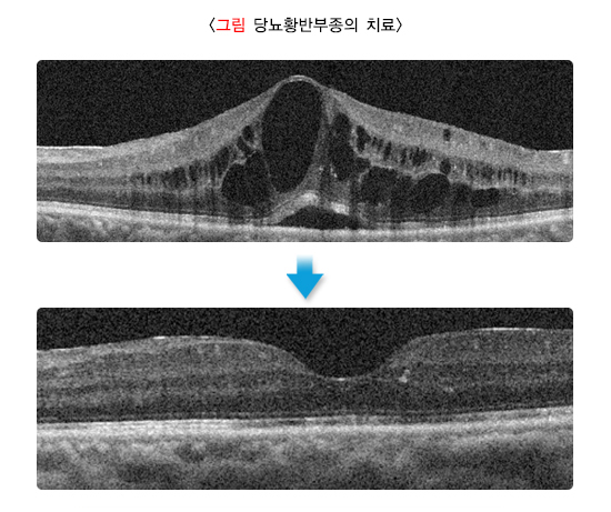그림 당뇨황반부종의 치료