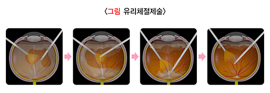 그림 유리체절제술