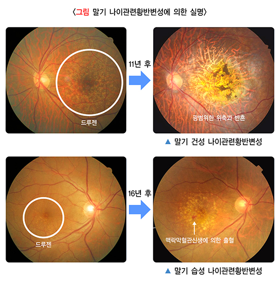 그림 말기 나이관련황반변성에 의한 실명