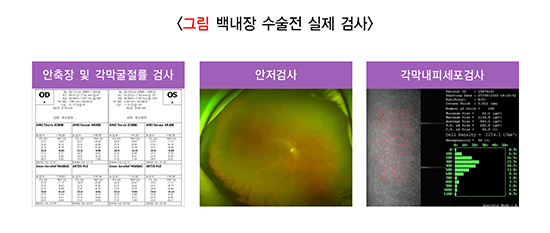 그림 백내장 수술전 실제 검사