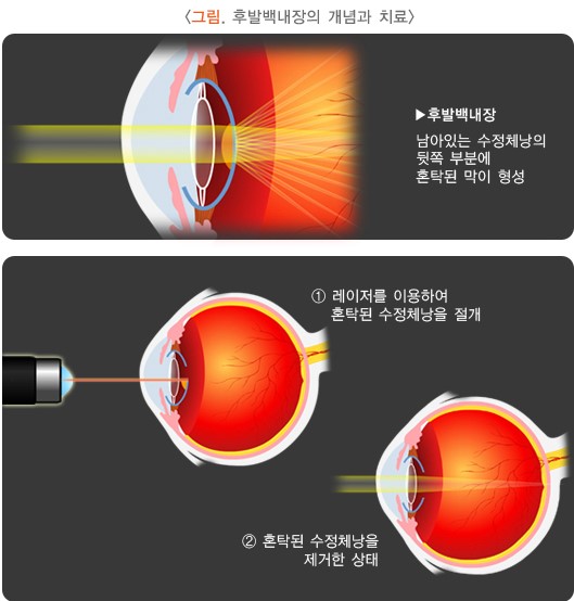 그림 후발백내장의 개념과 치료