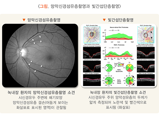 그림 망막신경섬유층촬영과 빛간섭단층활영