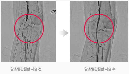 말초혈관질환 시술전, 말초혈관질환 시술후