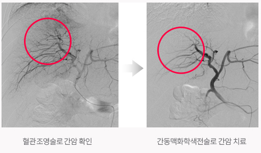 혈관조영술로 간암 확인, 간동맥화학색전술로 간암 치료