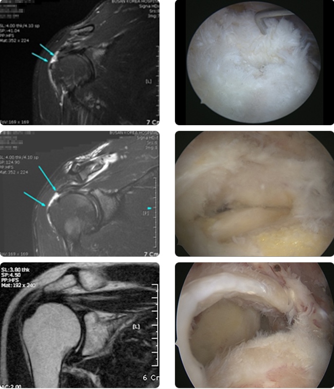 MRI와 실제 회전근개 사진