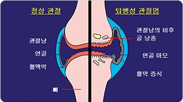 정상적인 무릎관절과 퇴행성관절염 사진