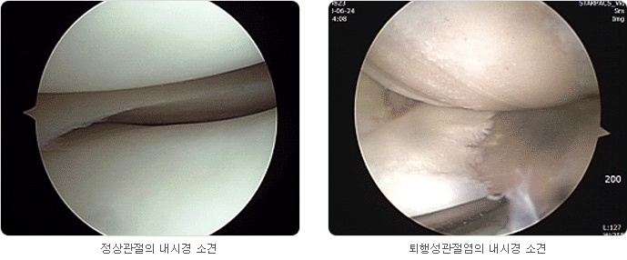 정상관절의 내시경 소견과 퇴행성관절염의 내시경 소견 사진