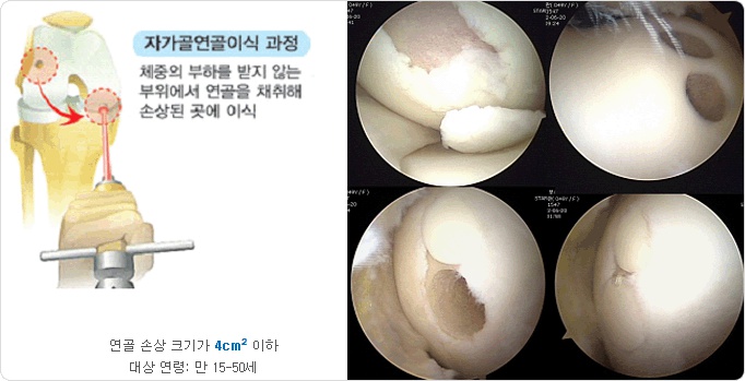 연골판 이식술