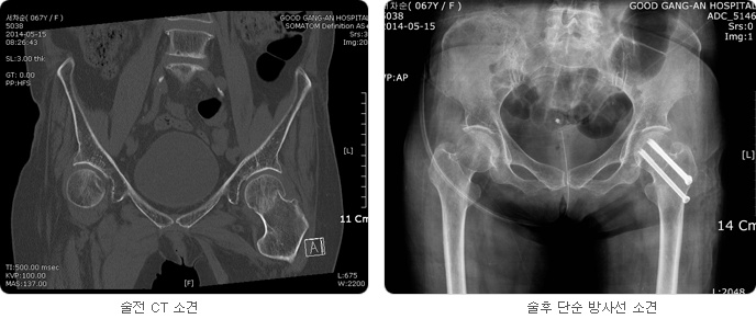  술전 CT 소견 사진과 술후 단순 방사선 소견 사진