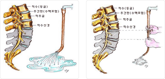 신경이 지나가는 통로인 척추관이 좁아지는 사진