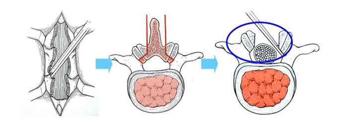 과거의 요추 협착증 수술 방법