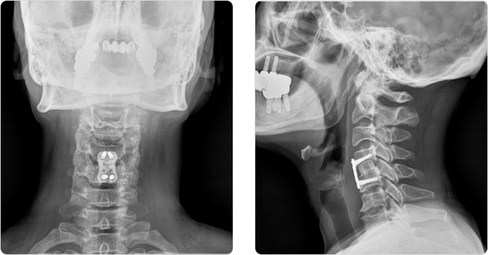 경추 유합술 정면 측면 사진