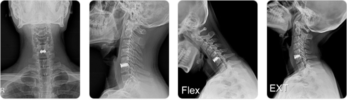경추부 인공 디스크 삽입 사진 그리고 운동성 비교