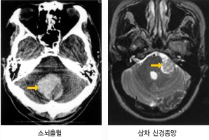 소뇌출혈과 삼차 신경종양 사진