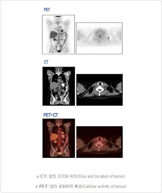 pet, ct, pet-ct 비교사진